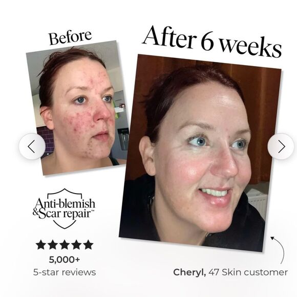 47 Skin Silver Mask, Anti-Blemish and Scar Repair w/Silver Chitoderm, 2 fl oz. - Picture 5 of 16